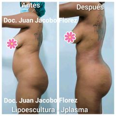 Lipoescultura - Dr. Juan Jacobo Florez