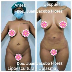 Lipoescultura - Dr. Juan Jacobo Florez