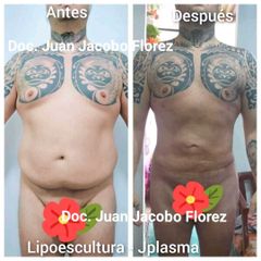 Lipoescultura - Dr. Juan Jacobo Florez