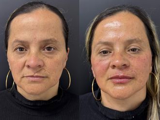 Cicatrices antes y después - 875282