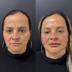 Cicatrices  - Dr. Antiedad