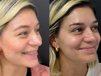 Bótox antes y después - 876954