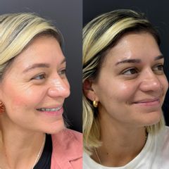 Bótox - Dr Antiedad