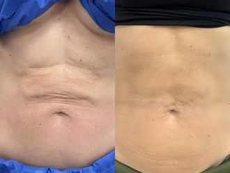 Lipólisis láser antes y después - 876955