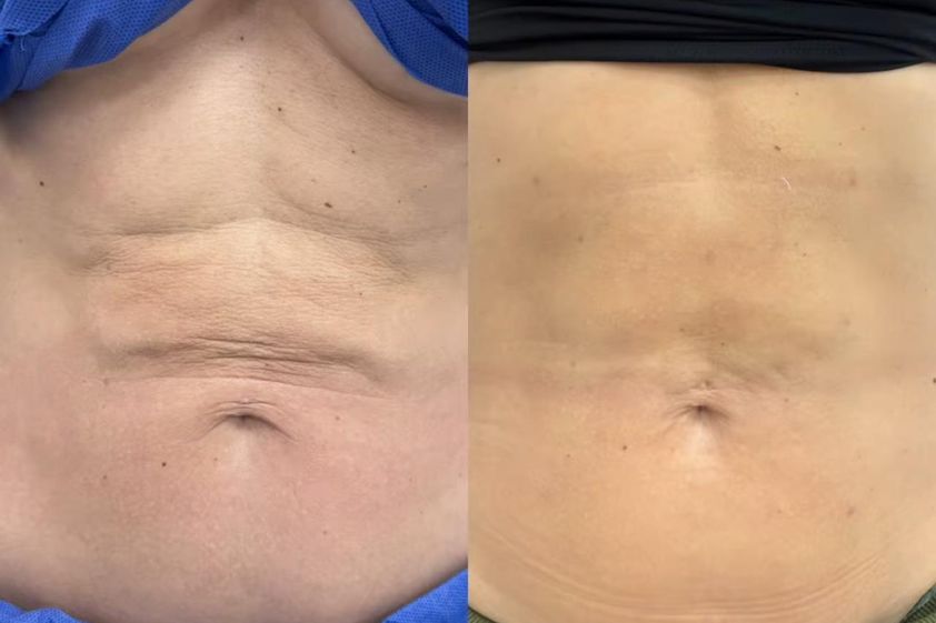 Lipólisis láser antes y después - 876955