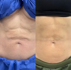 Endolift corporal - Dr. Antiedad