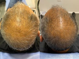 Alopecia antes y después - 876956