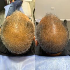 Terapia capilar- Dr. Antiedad