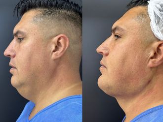 Eliminar grasa localizada antes y después - 876957