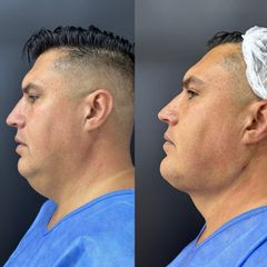 Endolift facial - Dr. Antiedad