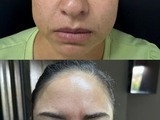 Manchas en la piel antes y después - 876958