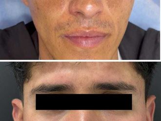 Manchas en la piel antes y después - 876959