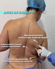 Endolift
