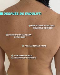 Endolift