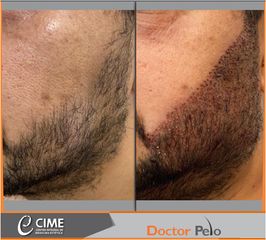 Tratamiento capilar - barba - Dr. Juan Guillermo Cadena