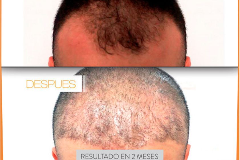 Implantes de cabello antes y después - 741355