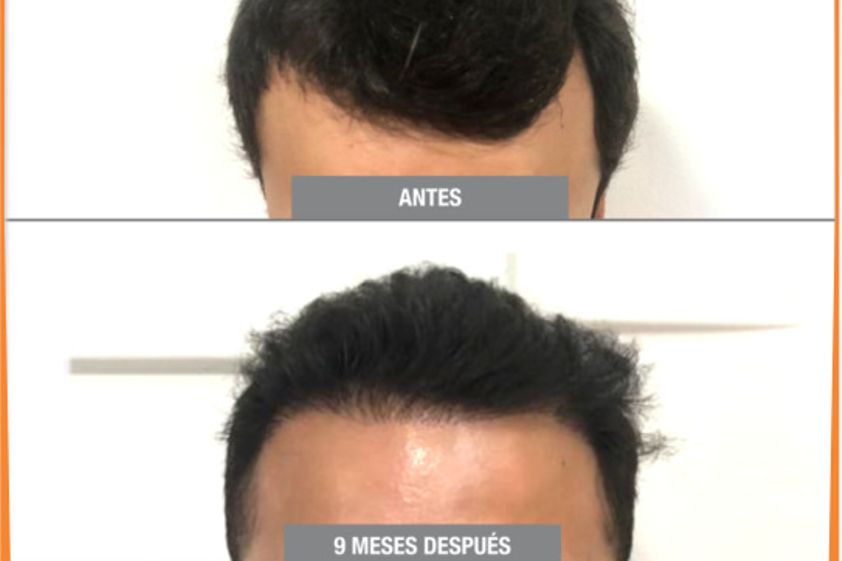 Trasplantes capilares antes y después - 741442
