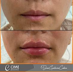 Aumento de labios - Dr. Juan Guillermo Cadena