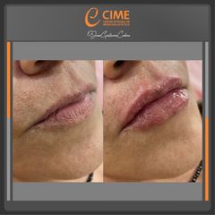 Aumento de labios - Dr. Juan Guillermo Cadena