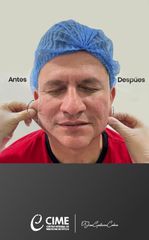 Rejuvenecimiento facial - Dr. Juan Guillermo Cadena