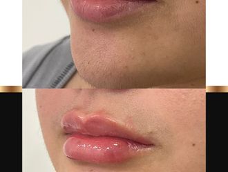 Aumento de labios - 863001
