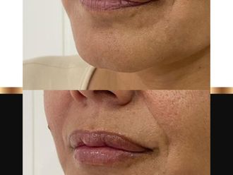 Aumento de labios - 863011
