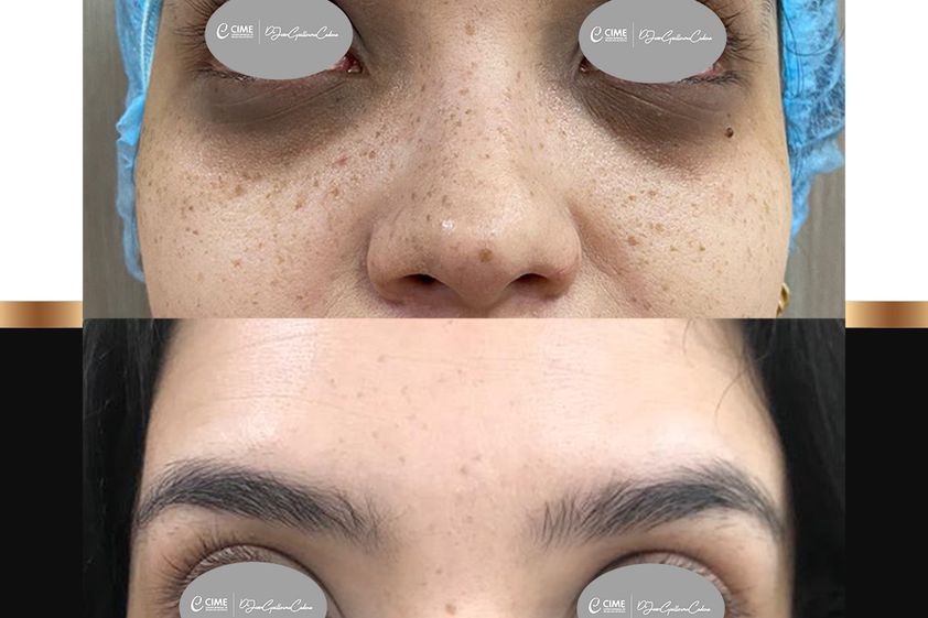 Eliminar ojeras antes y después - 863025