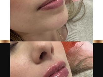 Aumento de labios - 863027