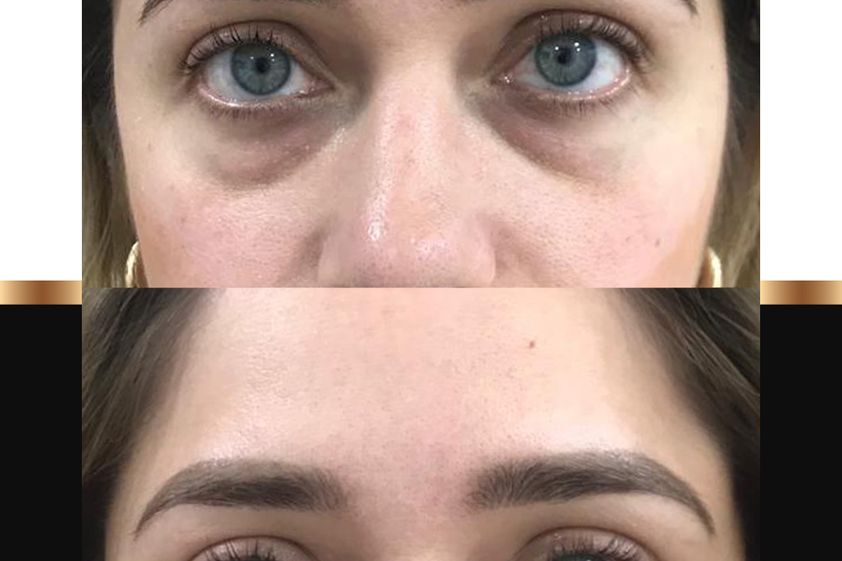 Eliminar ojeras antes y después - 863033