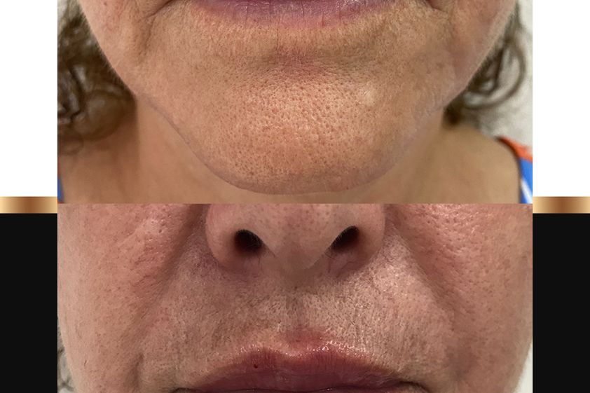 Aumento de labios antes y después - 863050