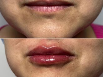 Aumento de labios antes y después - 873031