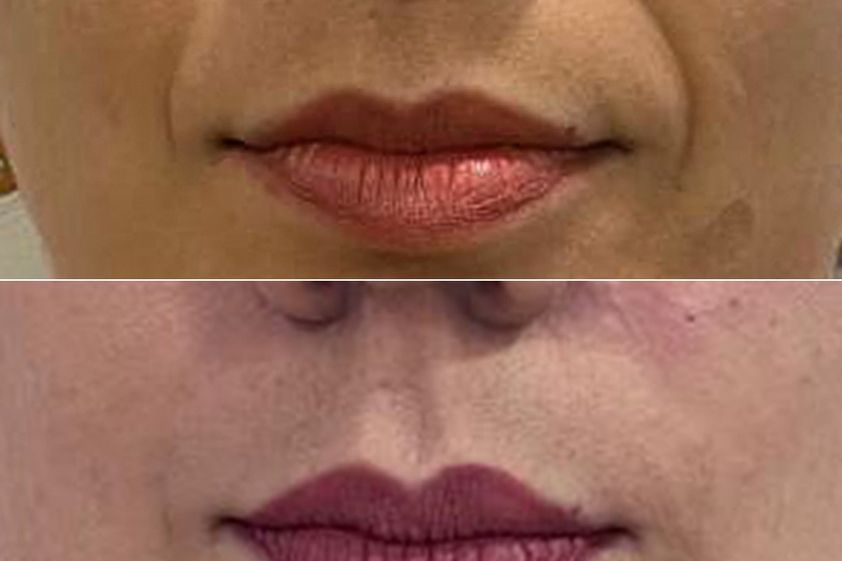 Hilos tensores antes y después - 873032