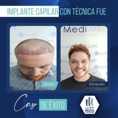 Implante Capilar - Mediarte