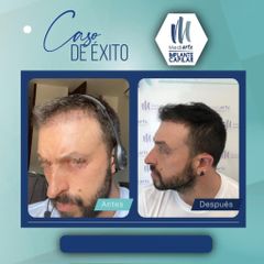 Implantes de cabello - Mediarte