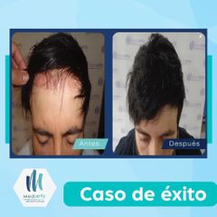 Implantes de cabello - Mediarte