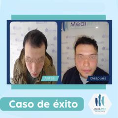 Implantes de cabello - Mediarte