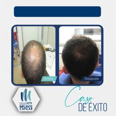 Implantes de cabello - Mediarte