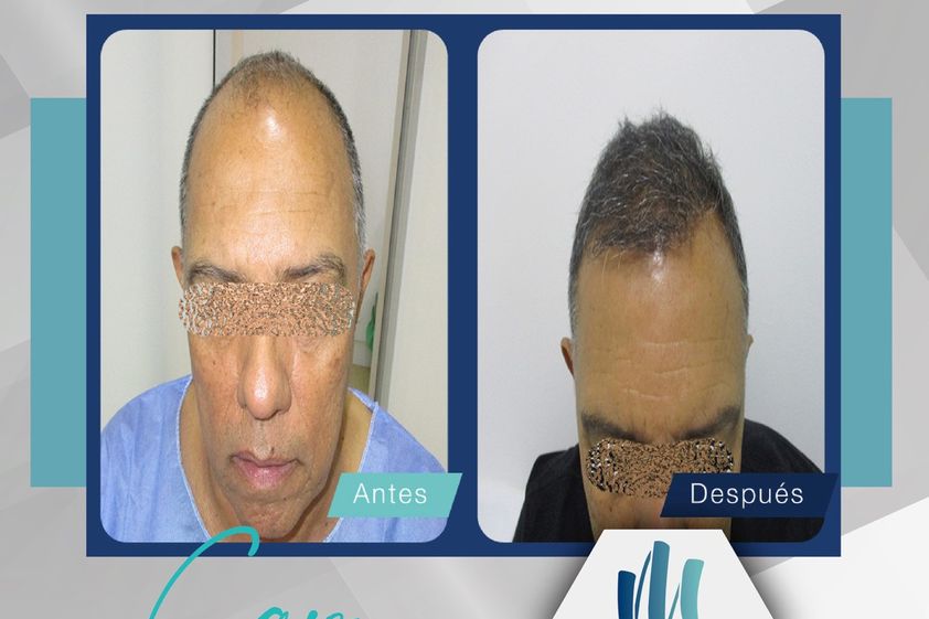 Implantes de cabello antes y después - 789514