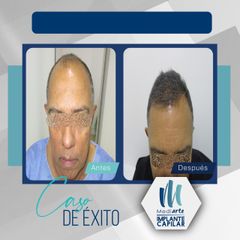 Implantes de cabello - Mediarte