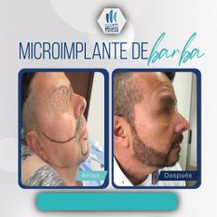 Implantes de cabello de barba - Mediarte