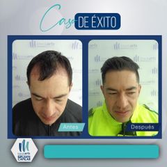 Implantes de cabello - Mediarte