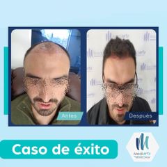 Implantes de cabello - Mediarte