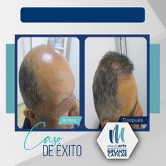 Implantes de cabello - Mediarte