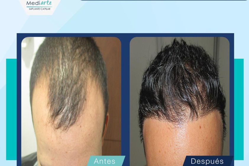 Trasplantes capilares antes y después - 789525