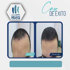 Implantes de cabello - Mediarte