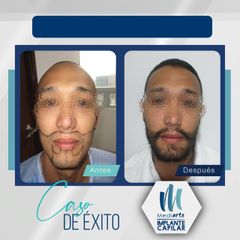 Implantes de cabello de barba - Mediarte