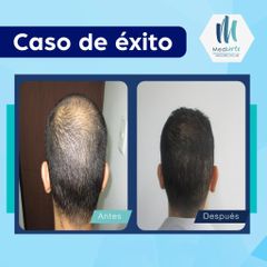 Implantes de cabello - Mediarte