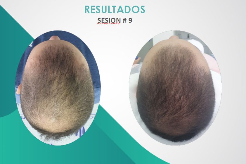 Plasma rico en plaquetas antes y después - 790048