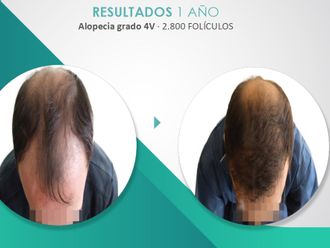 Alopecia - 790051