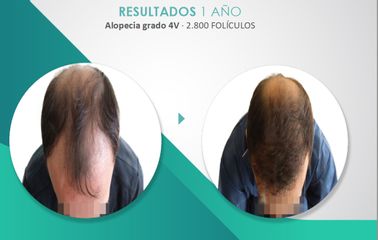 Alopecia - Mediarte